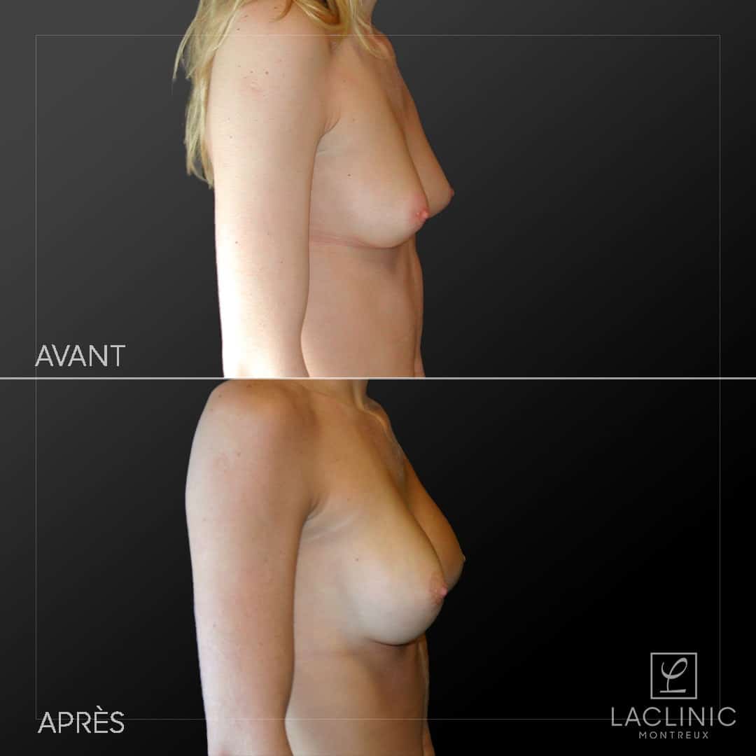 Augmentation mammaire avec implants photo avant-après